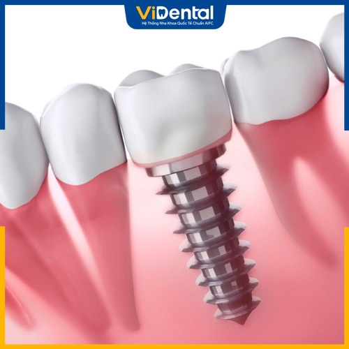 Trồng răng implant là giải pháp được nhiều người áp dụng