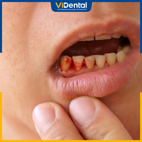 Chảy máu chân răng là vấn đề răng miệng cần chú ý