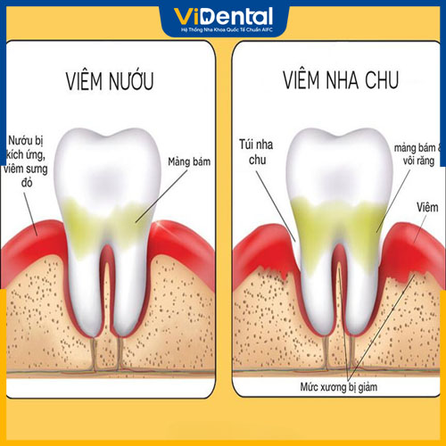 Nguyên nhân có thể do viêm nha chu hoặc viêm nướu