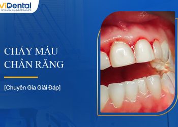 Chảy Máu Chân Răng : Nguyên Nhân, Triệu Chứng và Cách Trị Dứt Điểm