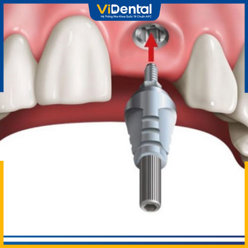 Implant là phương pháp phục hình răng cửa hiệu quả