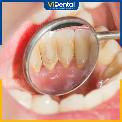 Cao răng có thể xảy ra do vệ sinh răng miệng kém