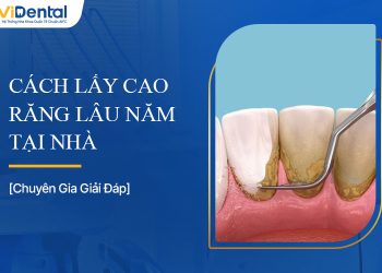 Cách Lấy Cao Răng Lâu Năm Tại Nhà An Toàn Và Hiệu Quả