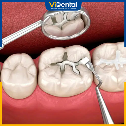 Nếu ê buốt răng do răng sâu, trám răng là biện pháp cho hiệu quả cao
