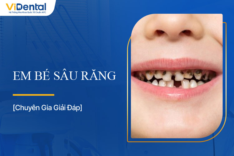Em Bé Sâu Răng: Nguyên Nhân, Dấu Hiệu Và Cách Phòng Ngừa