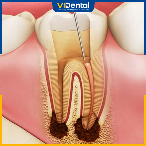 Cần lấy tủy răng khi răng bị tổn thương nặng