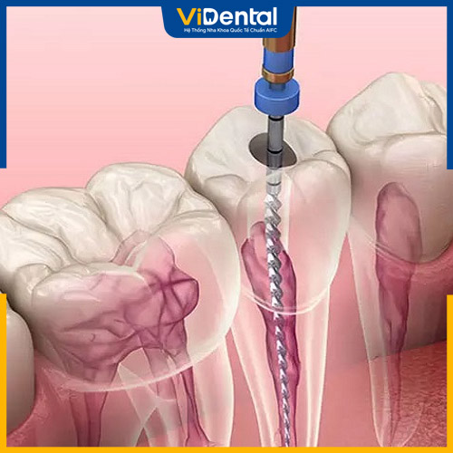 Lấy tủy răng số 7 bao nhiêu tiền tùy thuộc vào các yếu tố khác nhau