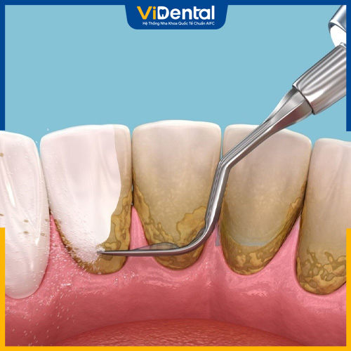 Tẩy vôi răng là phương pháp nha khoa thường dùng