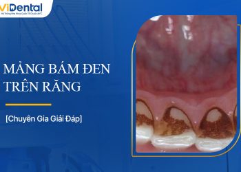 Mảng Bám Đen Trên Răng: Nguyên Nhân Và Cách Khắc Phục
