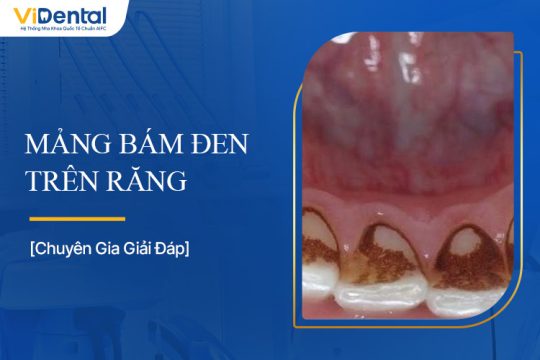 Mảng Bám Đen Trên Răng: Nguyên Nhân Và Cách Khắc Phục