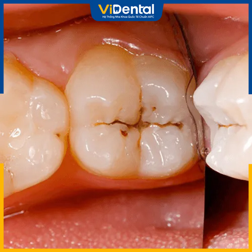 Nhai nhiều 1 bên còn dễ gây ra sâu răng