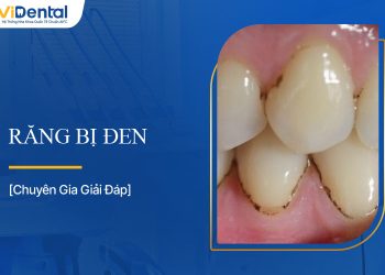Răng Bị Đen: Nguyên Nhân và Cách Khắc Phục Hiệu Quả