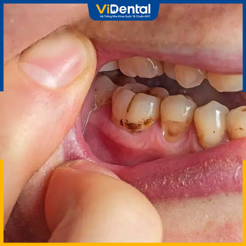 Răng bị đen gây ra tình trạng mất thẩm mỹ rõ rệt