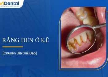 Răng Bị Đen Ở Kẽ: Nguyên Nhân và Giải Pháp Khắc Phục