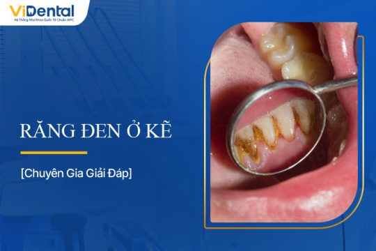 Răng Bị Đen Ở Kẽ: Nguyên Nhân và Giải Pháp Khắc Phục
