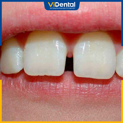 Răng cửa thưa có thể gây ảnh hưởng sức khỏe răng miệng