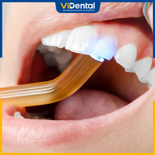 Trám răng là phương pháp nha khoa được ứng dụng phổ biến