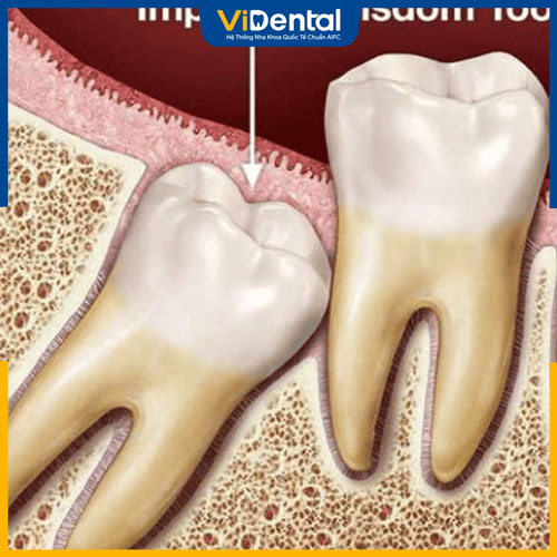 Răng khôn là răng số mấy? Răng số 8 trong góc hàm