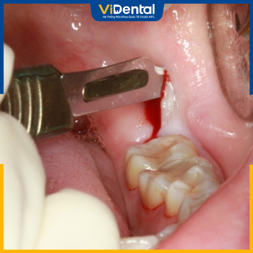 Răng khôn mọc lệch nhưng không đau có nên nhổ? Nên tham khảo ý kiến bác sĩ