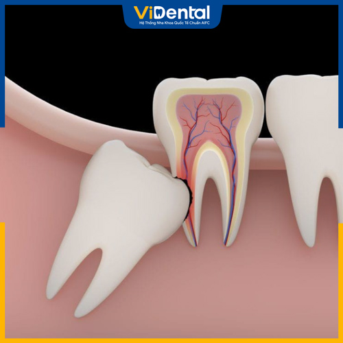 Răng khôn dễ mọc lệch và gây ra đau nhức