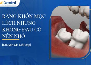 Răng Khôn Mọc Lệch Nhưng Không Đau Có Nên Nhổ?