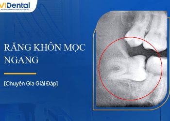Răng Khôn Mọc Ngang: Nguyên Nhân, Dấu Hiệu Và Cách Xử Lý