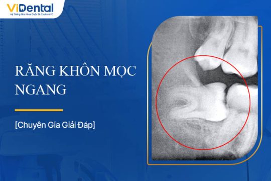 Răng Khôn Mọc Ngang: Nguyên Nhân, Dấu Hiệu Và Cách Xử Lý
