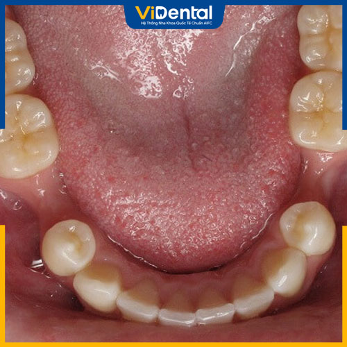 Tiêu xương hàm dễ xảy ra khi mất răng quá lâu