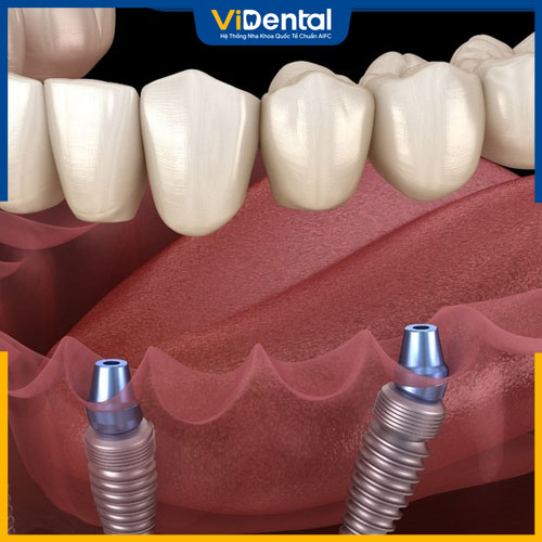 Trồng Implant là giải pháp điều trị tiêu xương hàm hiệu quả