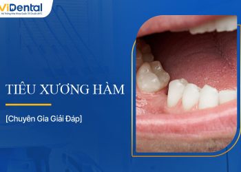 Tiêu Xương Hàm: Nguyên Nhân, Triệu Chứng Và Cách Điều Trị