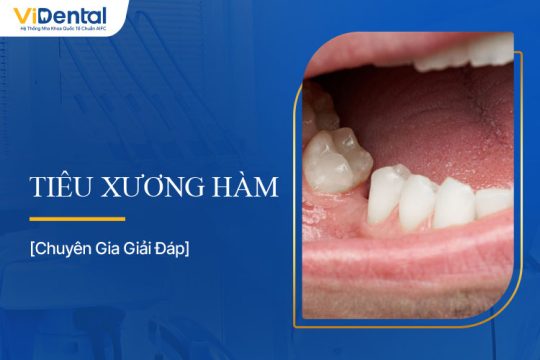 Tiêu Xương Hàm: Nguyên Nhân, Triệu Chứng Và Cách Điều Trị