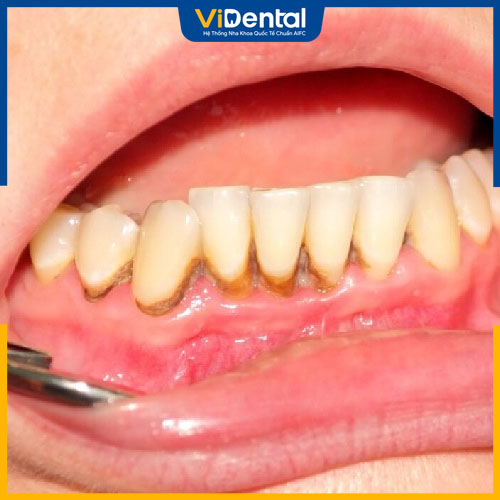 Vôi răng dễ hình thành do thói quen vệ sinh răng miệng
