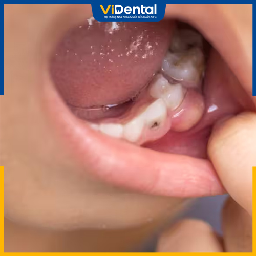 Vôi răng tự tróc có thể gây ra nhiễm trùng răng miệng