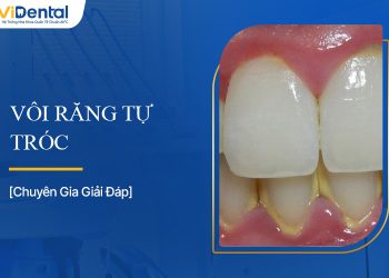 Vôi Răng Tự Tróc: Hiện Tượng Này Là Gì Và Có An Toàn Không?