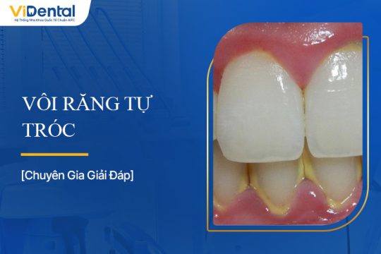 Vôi Răng Tự Tróc: Hiện Tượng Này Là Gì Và Có An Toàn Không?