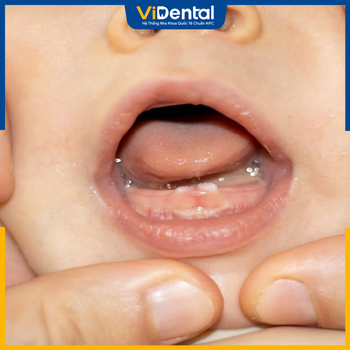 Trẻ chậm mọc răng có thể do thiếu chất hoặc di truyền