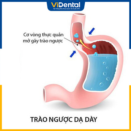Trào ngược dạ dày có thể là nguyên nhân gây hôi miệng từ bên trong