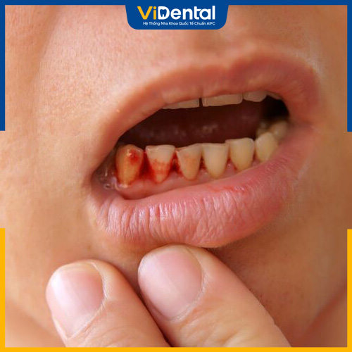 Chảy máu chân răng ung thư hay do viêm nhiễm răng miệng?