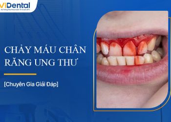 Chảy Máu Chân Răng Ung Thư Hay Chỉ Là Vấn Đề Răng Miệng?