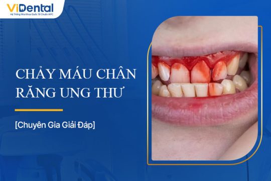 Chảy Máu Chân Răng Ung Thư Hay Chỉ Là Vấn Đề Răng Miệng?