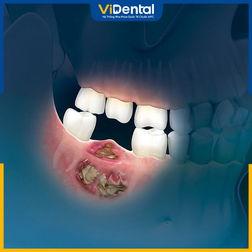 Hoại tử xương hàm là tình trạng mô xương hàm bị chết
