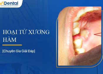 Hoại Tử Xương Hàm: Triệu Chứng, Nguyên Nhân, Cách Chữa