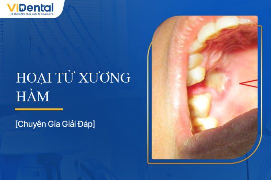 Hoại Tử Xương Hàm: Triệu Chứng, Nguyên Nhân, Cách Chữa