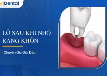 Lỗ Sau Khi Nhổ Răng Khôn: Bạn Cần Biết Gì?