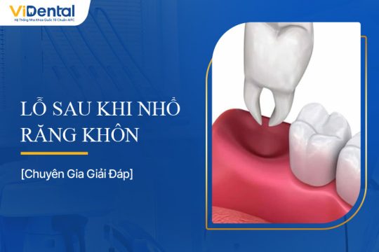 Lỗ Sau Khi Nhổ Răng Khôn: Bạn Cần Biết Gì?