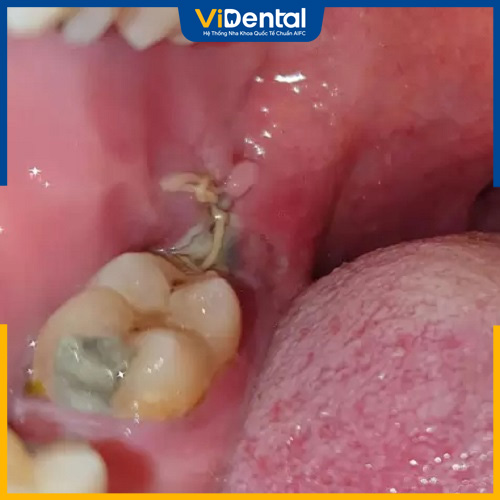 Màng trắng sau khi nhổ răng không phải tình trạng nguy hiểm