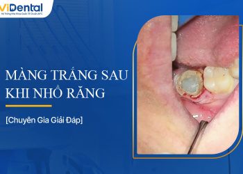 Màng Trắng Sau Khi Nhổ Răng: Hiểu Để An Tâm