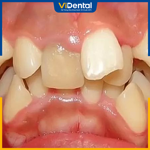 Răng bị lồi xỉ có thể do thói quen đẩy lưỡi hoặc cắn vật cứng
