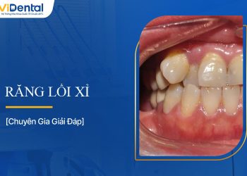 Răng Lồi Xỉ: Nguyên Nhân, Ảnh Hưởng, Cách Khắc Phục
