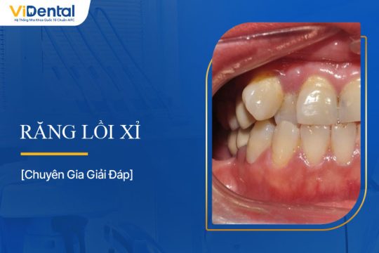 Răng Lồi Xỉ: Nguyên Nhân, Ảnh Hưởng, Cách Khắc Phục